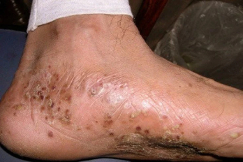 eczema treatment in PUNE Card image cap