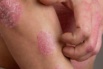 best psoriasis treatment in PUNECard image cap